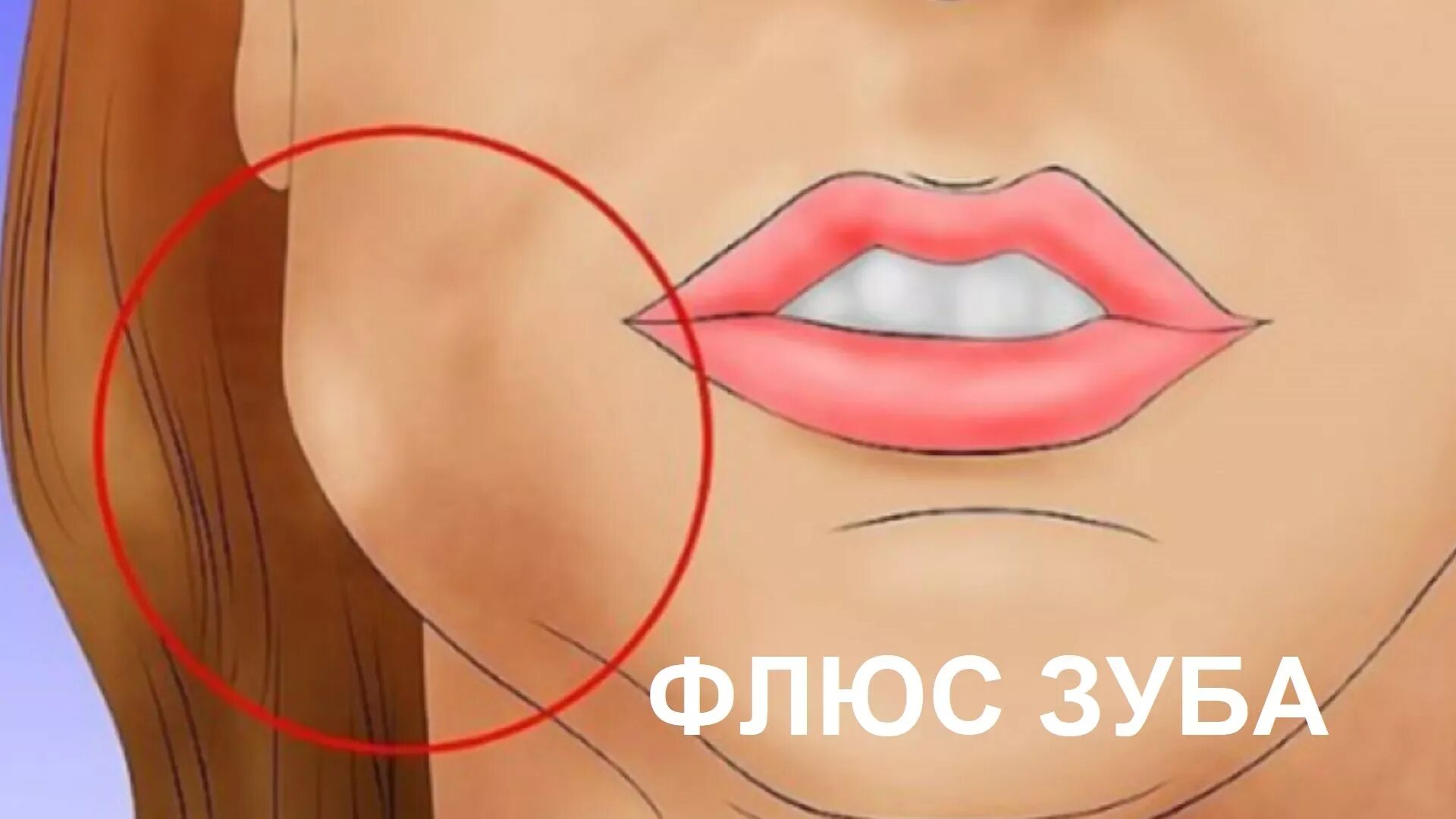 Опухшая щека на нижней челюсти. Периостит челюсти (флюс).