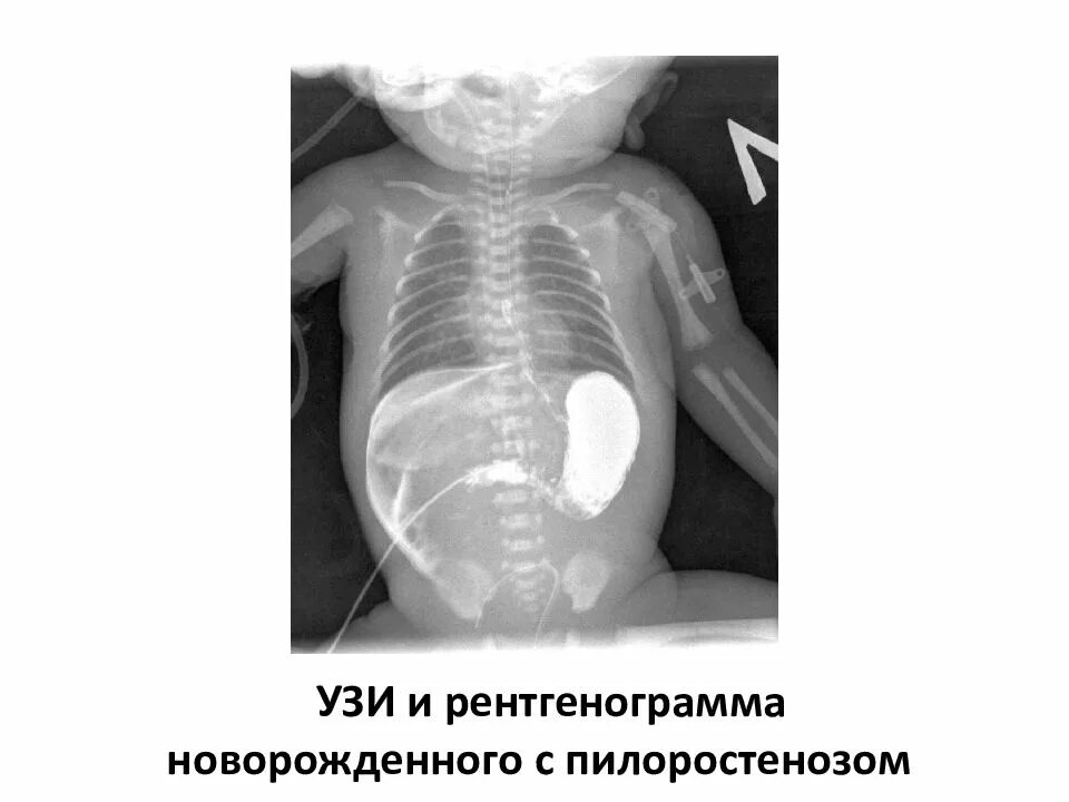 Пилоростеноз у новорожденных рентген. Пилоростеноз желудка у новорожденных. Врожденный пилоростеноз. Пилороспазм и пилоростеноз.