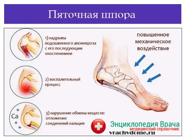 Синдром шпора пяточная. Болезнь пяточная шпора. бывает ли шпора сбоку пятки. пяточные шпоры симптомы. терапия пяточной шпоры.