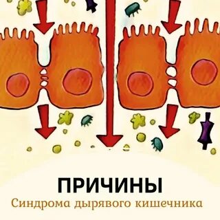 Дырявый кишечник что это