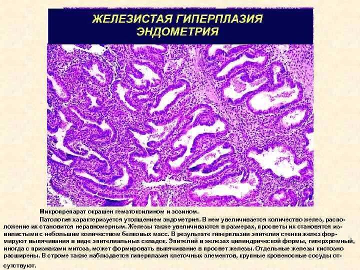 Смешанная эндометрия. Гиперплазия эндометрия микропрепарат. Железисто-кистозная гиперплазия эндометрия микропрепарат. Железистая гиперплазия эндометрия гистология. Железистая гиперплазия слизистой оболочки матки микропрепарат.