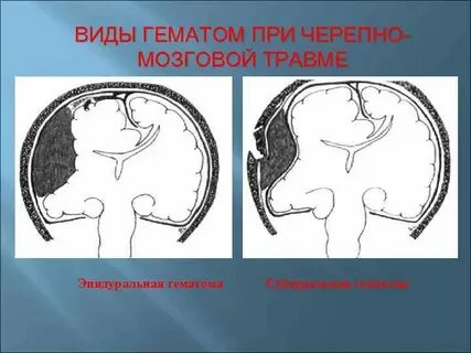 Черепно мозговая травма гематома