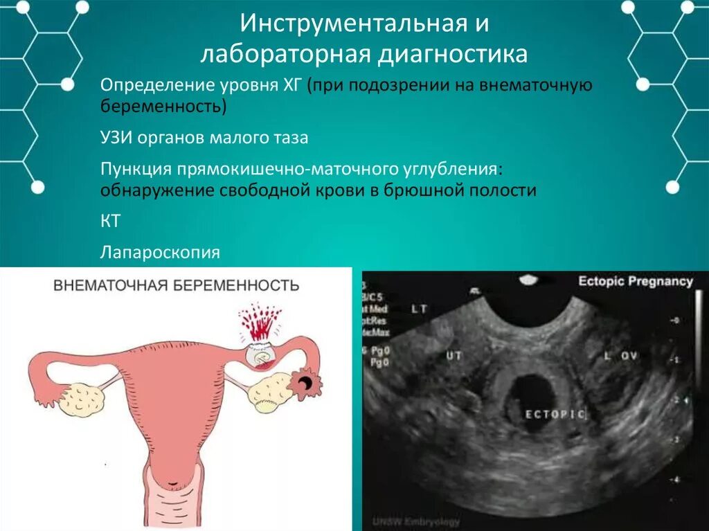 Почему происходит внематочная. Инструментальная диагностика внематочной беременности. Внематочная беременность на УЗИ. Внематочная беременность йото. Внематочная беременность фото.