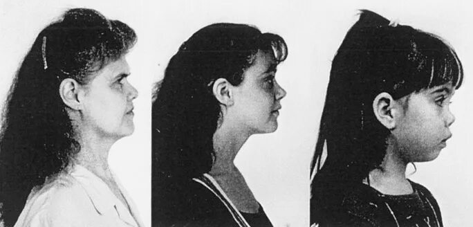 Синдром маршала у детей. Синдром маршала стиклера. синдром стиклера симптомы.