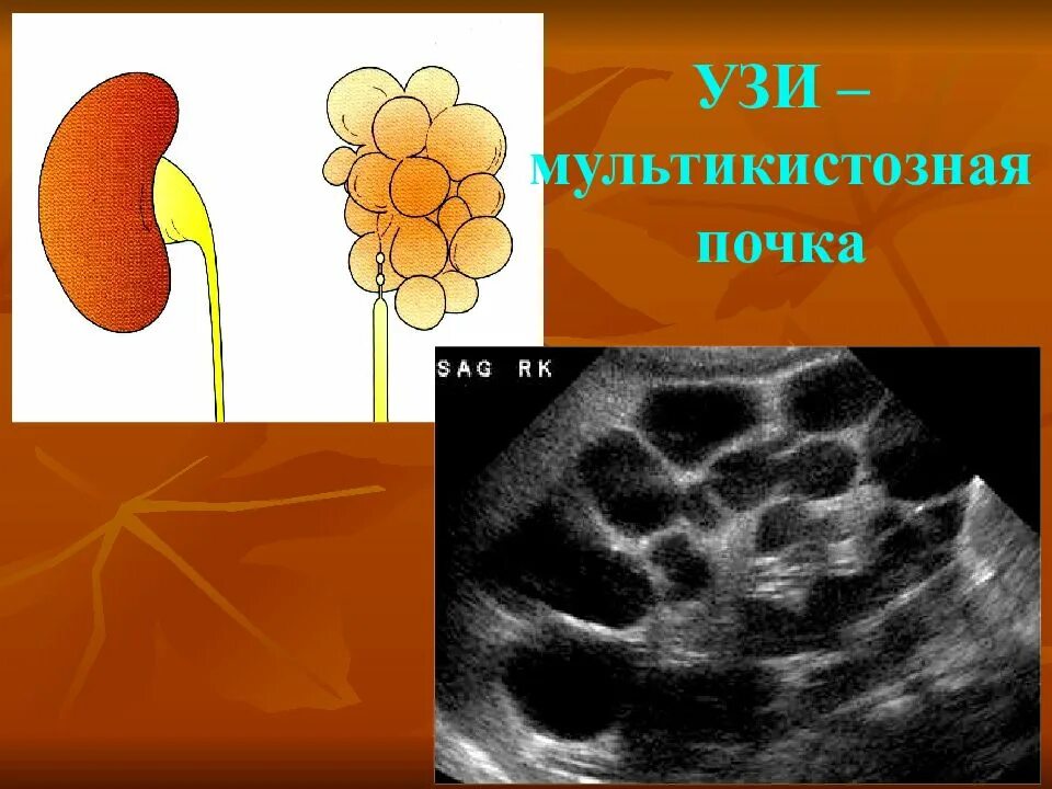 Мультикистозная почек плода. Мультикистозная дисплазия почки. кистозная дисплазия почек узи. узи признаки мультикистозной почки.