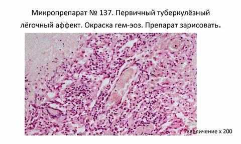 Первичный туберкулезный аффект