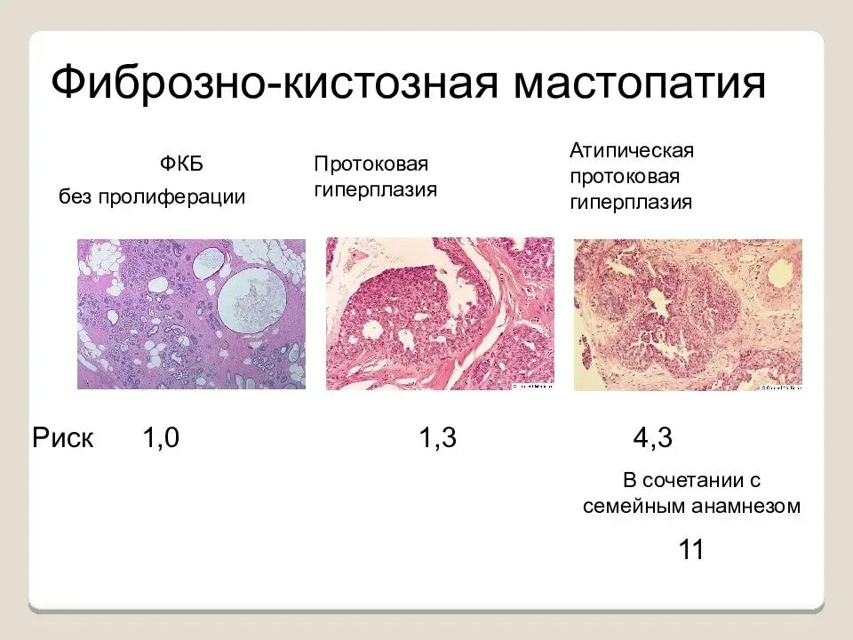 Признаки кистозных изменений. Фиброзно-кистозная мастопатия патанатомия. Фиброзно-кистозная мастопатия патологическая анатомия. Фиброзно-кистозная мастопатия микропрепарат. Пролиферативная фиброзно кистозная мастопатия гистология.