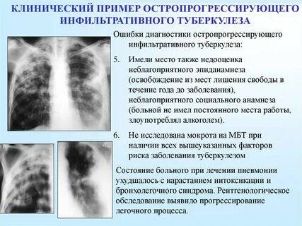 Диагностика туберкулеза рентген