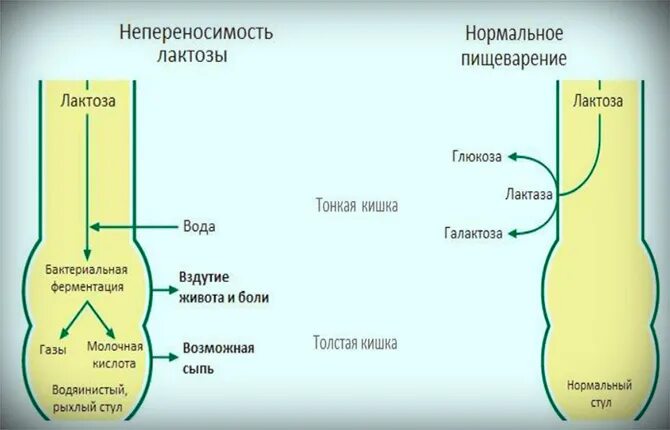 Как проявляется непереносимость лактозы у взрослых симптомы. Как проявляется непереносимость лактозы у взрослых симптомы