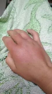 Отеки пальцев рук по утрам причины