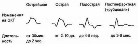 Экг признаком острейшей стадии инфаркта миокарда является