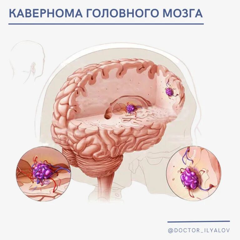 Ангиома мозга лечение. Церебральный кистозный арахноидит. Кавернозная ангиома головного.