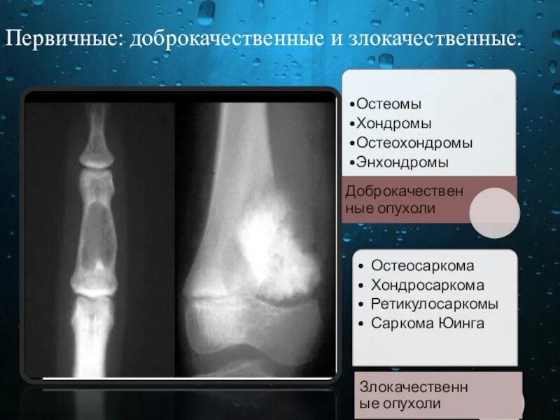 Доброкачественная остеома. Остеома бедренной кости. Доброкачественная остеома. Остеома большеберцовой кости. Опухоли большеберцовой кости остеома.