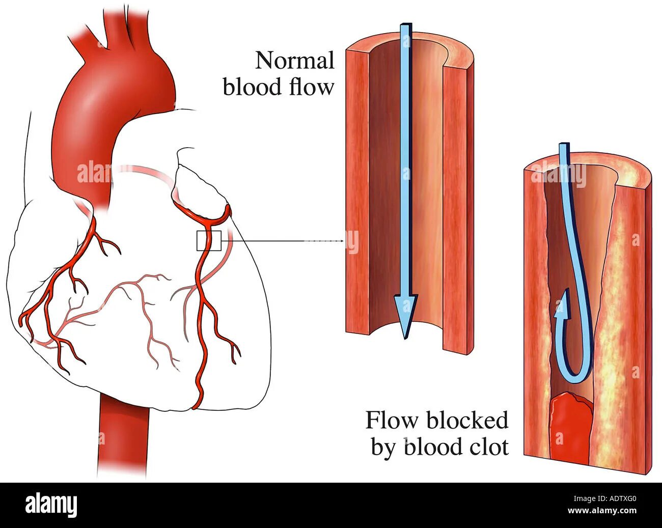 Тромбоз артерий сердца. Тромбоз коронарных сосудов. Сердечный тромбоз