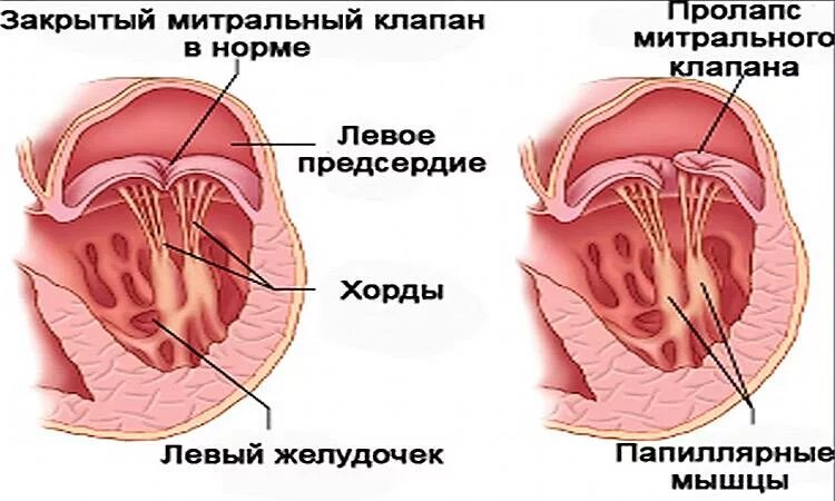 Митральный клапан сердца. Лишние хорды в сердце что. В митральном клапане дополнительные хорды. Дополнительная продольная хорда левого желудочка. Хорда в полости левого желудочка.