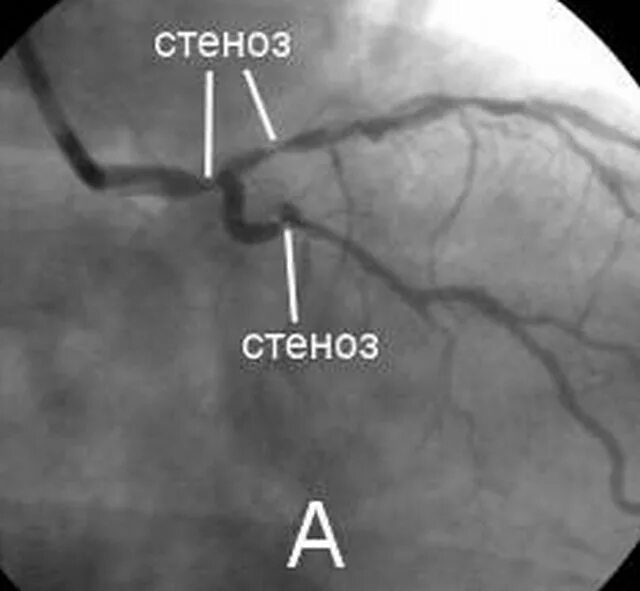 Острый стеноз гортани у детей клиника. Признаки острого стенозирующего ларинготрахеита:. Клинические проявления стеноза гортани. Стеноз устья аорты клиника. Инфаркт миокарда окклюзия артерий.