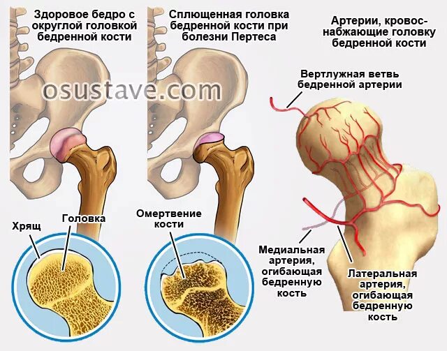 Коксартроз тазобедренного инвалидность положена. Остеохондропатия головки бедренной кости (болезнь пертеса). болезнь пертеса тазобедренного сустава у детей. стадии болезни пертеса головки бедренной кости. болезнь легга кальве пертеса.