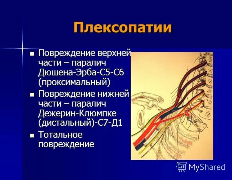 Периферические нервы и сплетения. Поражение плечевого сплетения неврология. Поражение плечевого сплетения симптомы. Верхний плексит плечевого сплетения. Синдром поражения плечевого сплетения.