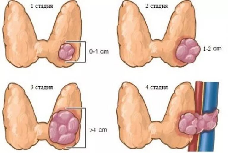 Щитовидная железа стадии рака