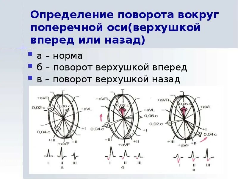 Поворот сердца вокруг поперечной оси верхушкой назад. Поворот вокруг поперечной оси верхушкой вперед. Поворот оси сердца. Повороты сердца на ЭКГ вокруг продольной оси. Поворот правым желудочком вперед