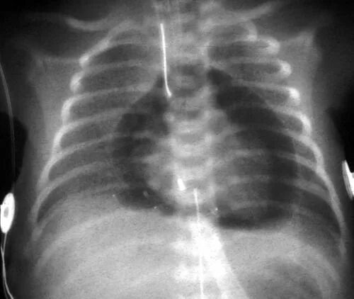 The Chest Radiograph in Cardiovascular Disease Thoracic Key