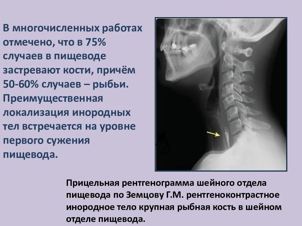 Застряло в пищеводе что делать