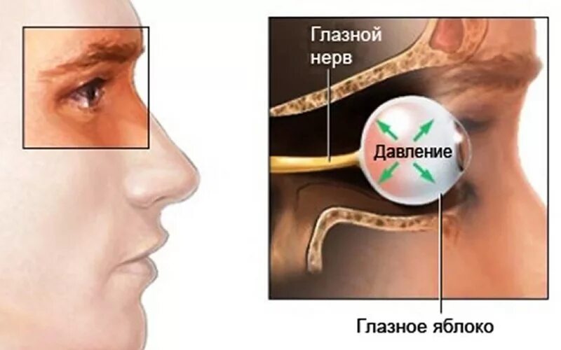 Внутриглазное давление лечение. Воспаление глазного нерва. Неврит глазного нерва симптомы. Снижение внутриглазного давления.