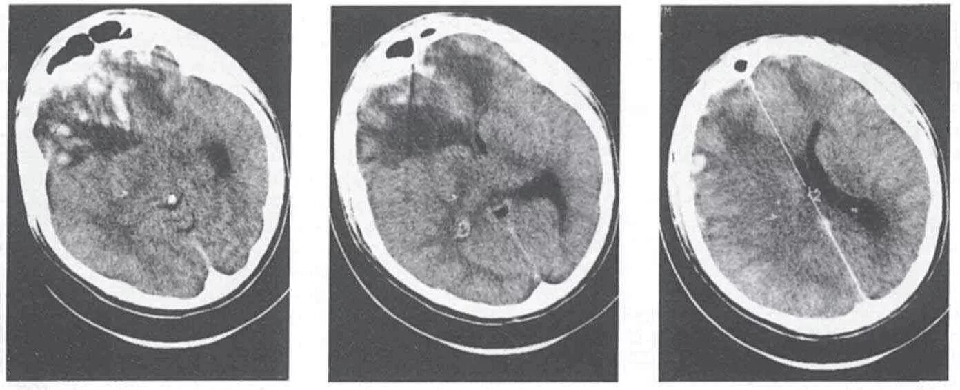 Черепно мозговые гематомы. Ушиб головного мозга кт степени. Ушиб головного мозга средней степени кт. Гигрома головного мозга кт.