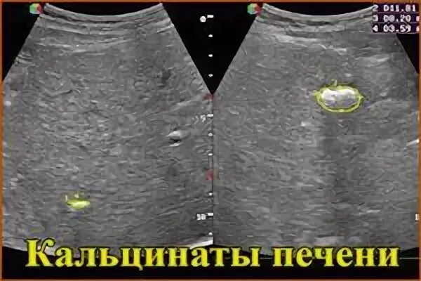 Кальцинат правой доли печени что это