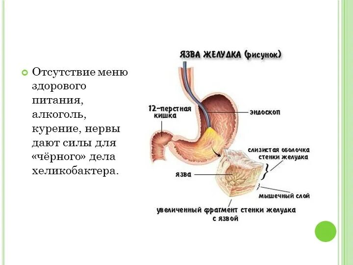 Как изменяется пища в двенадцатиперстной кишке. Курение и язвенная болезнь. язва желудка от курения. язвенная болезнь желудка и двенадцатиперстной кишки.