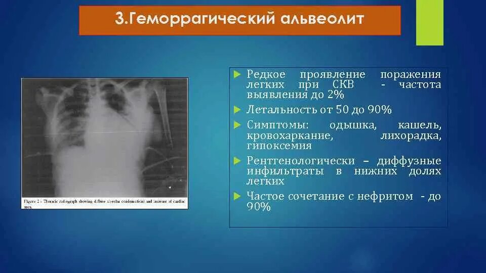 Системная красная волчанка плеврит. Поражение цнс при скв. Эозинофильная инфильтрация легких кт. Диссеминированных заболеваний легких. Системная красная волчанка кт легких.
