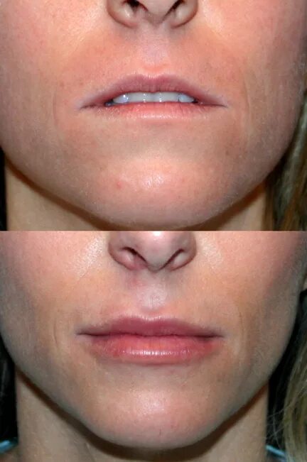 Губы становятся тоньше. Аристократические черты лица. Коррекция возрастных губ фото до и после. Растут ли губы с возрастом. Красивое увеличение губ.