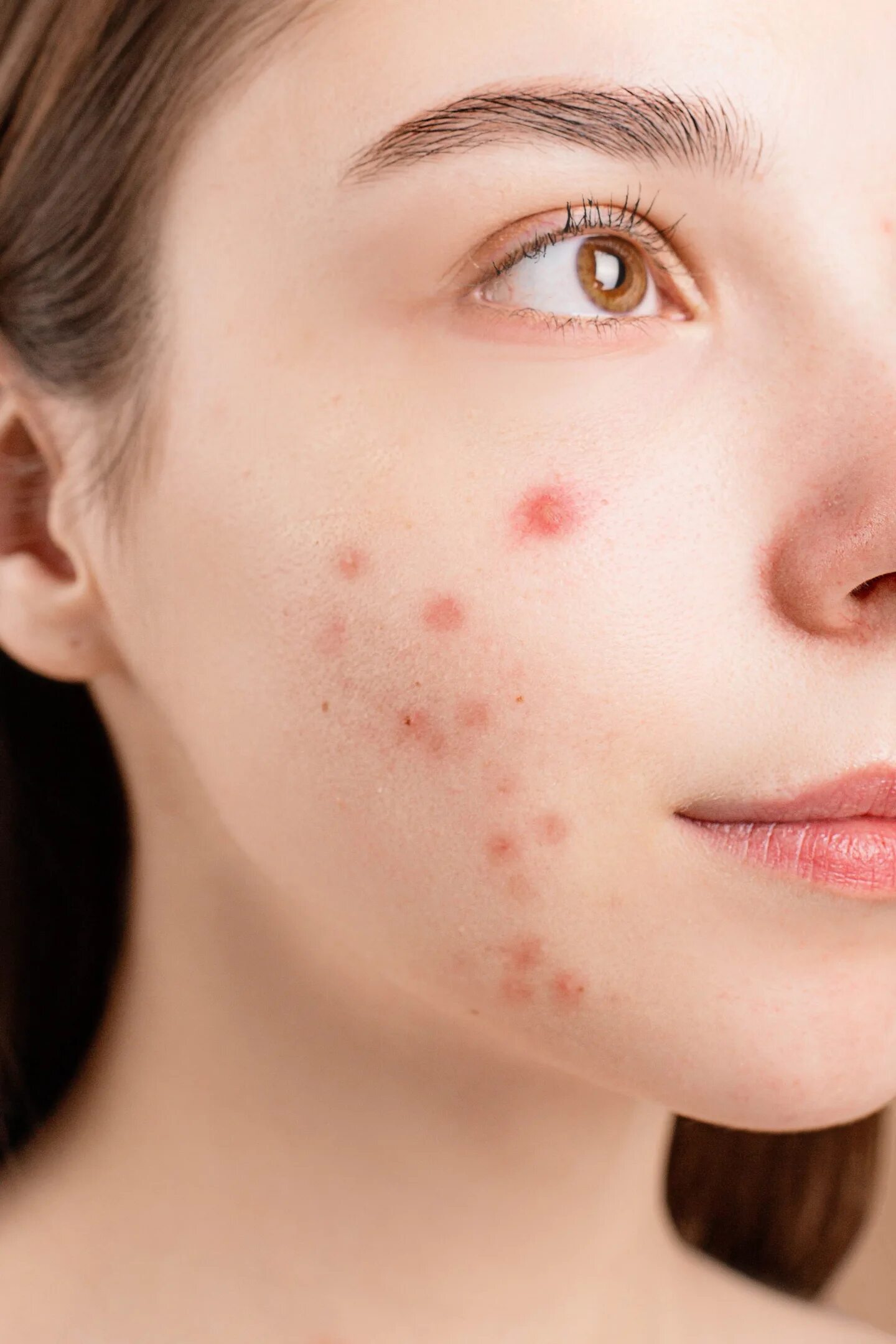 Acne pimple. Acne pimple