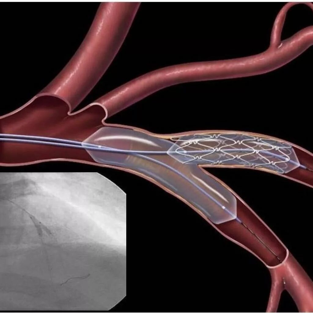 Операция коронарный сосуд. Операция стентирование сосудов сердца. Баллонная ангиопластика сосудов. Коронарная ангиопластика и стентирование. ТРАНСЛЮМИНАЛЬНАЯ баллонная коронарная ангиопластика.