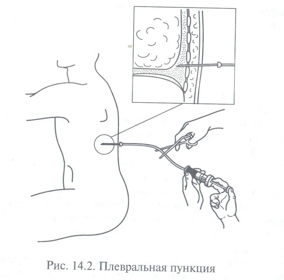 Пункция через задний свод. Разгрузочная пункция плевральной полости. Пункция плевральной полости схема. Оснащение для пункции плевральной полости. Пункция плевральной полости по Петрову.