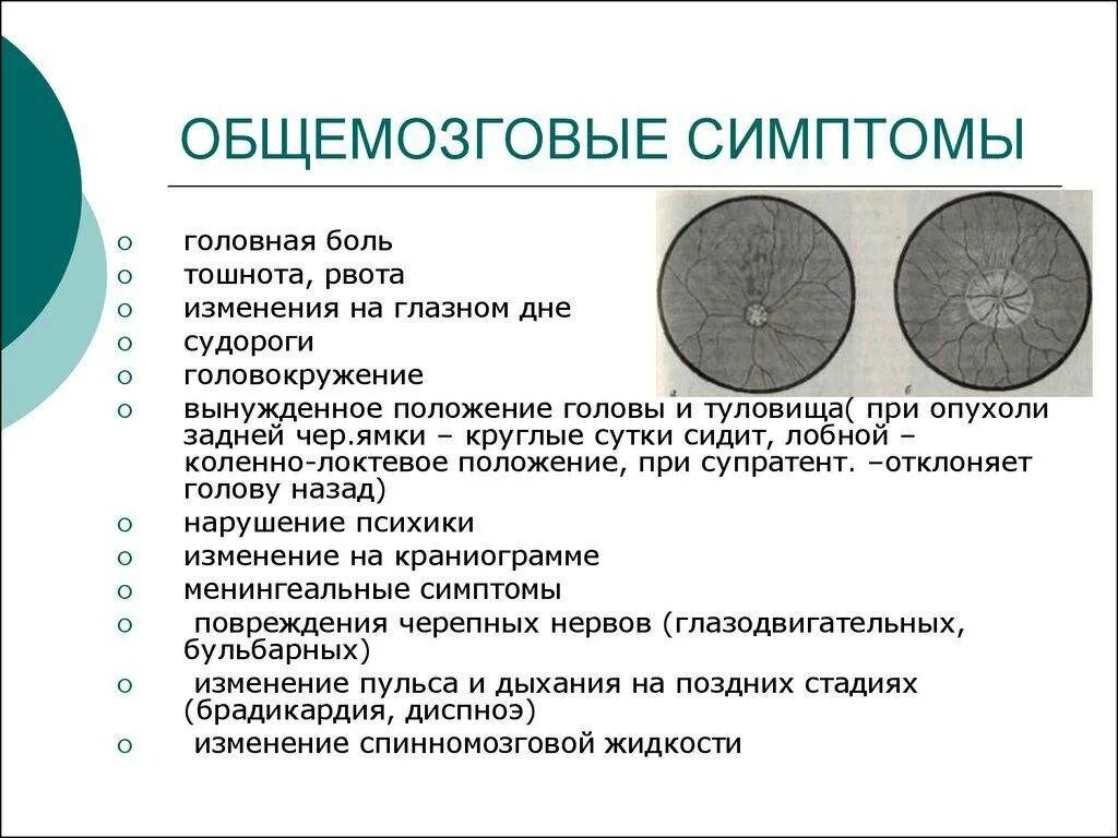 Симптомы опухоли головного мозга на ранних стадиях. Головная боль при опухоли головного мозга. Начальные симптомы опухоли головного мозга. Общемозговые симптомы опухолей головного мозга. Опухоль головного мозга симптомы.