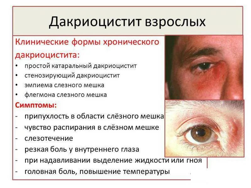 Причина боли под глазами. Воспаление слезного мешка. Хронический дакриоцистит. Признак острого дакриоцистита.