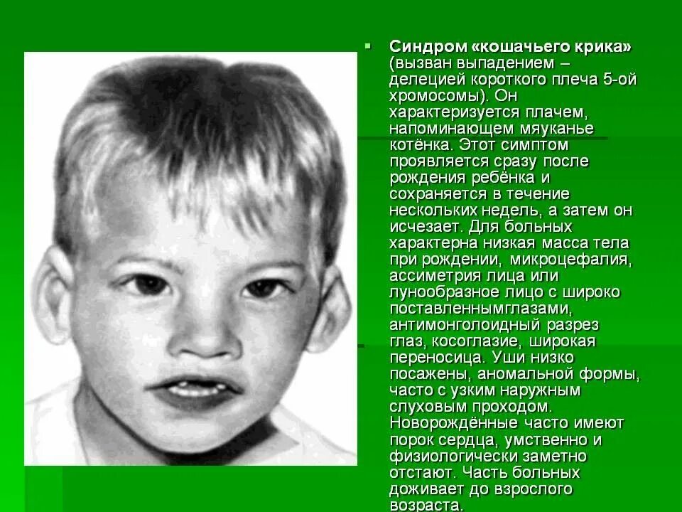 У кого 48 хромосом. Синдром кошачьего крика делеция. синдром кошачьего крика трисомия. хромосомные заболевания синдром кошачьего крика. синдром кошачьего крика (делеция в 5-ой хромосоме);.
