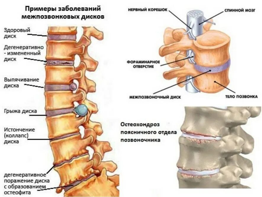 Межпозвонковый остеохондроз (поражение до 3 межпозвонковых дисков). Остеохондроз межпозвонковых дисков пояснично крестцового отдела. Остеохондроз крестцового отдела позвонка. Остеохондроз 3 и 4 позвонка поясничного отдела.