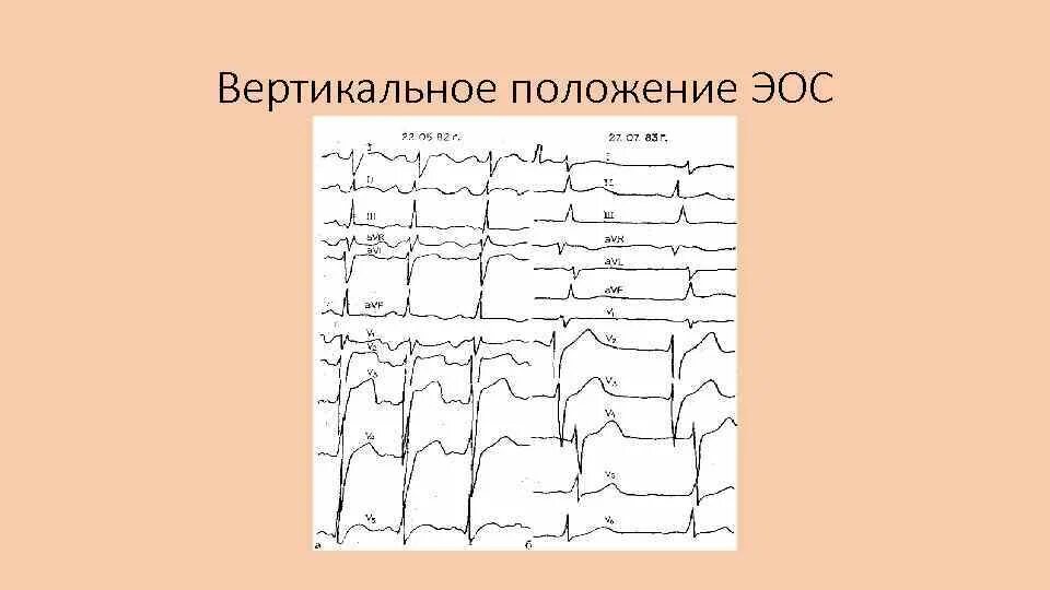 Вертикальная позиция сердца. ЭОС вертикальная на ЭКГ что это. Вертикальное положение ЭОС. Вертикальное положение электрической оси. ЭОС вертикальная позиция.