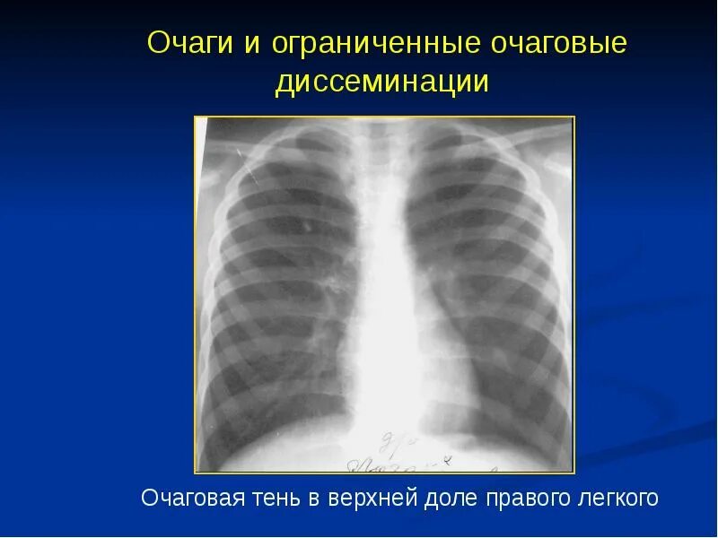 Тень в верхней доле. Ограниченная диссеминация легких рентген. Синдром очагов и ограниченной диссеминации. Синдром очаговой диссеминации рентген. Синдром очаговой тени на рентгене.