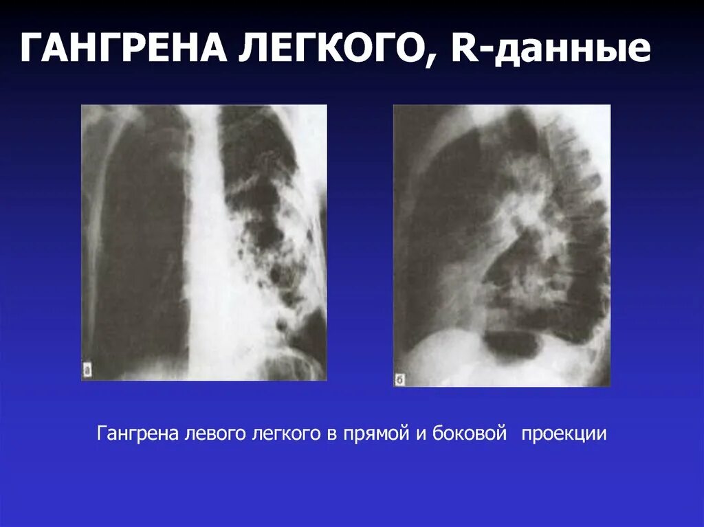 Лобарная гангрена легкого. Гангрена легкого на рентгенограмме. Гангрена левого легкого. Тотальная гангрена легкого. 1 абсцесс легкого