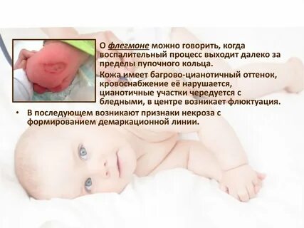 У ребенка болит пуп