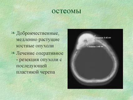 Остеома