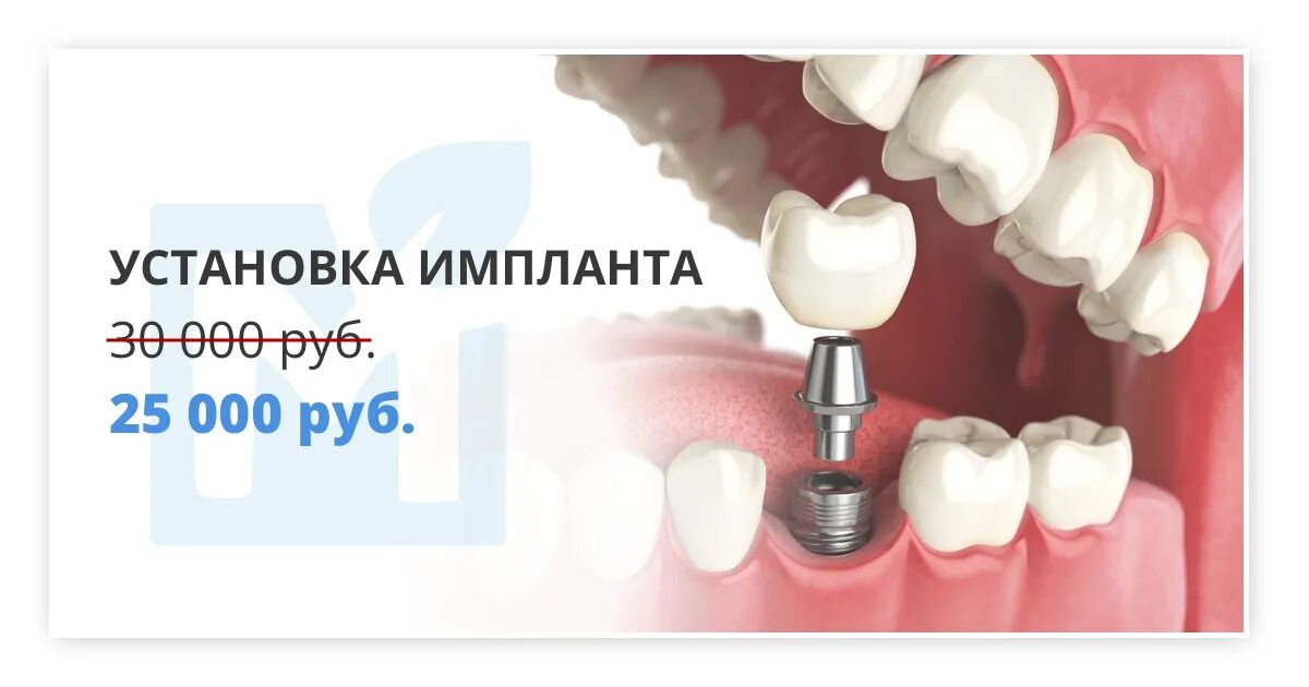 Через сколько можно вставить зубы. Имплантация зубов под ключ. Имплант под ключ. Импланты зубов в рассрочку. Имплант с коронкой под ключ.