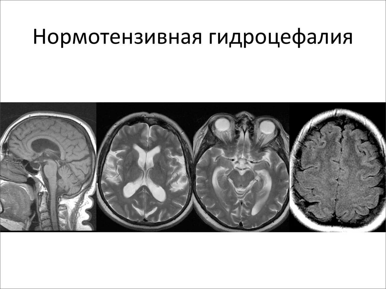 Неокклюзионная гидроцефалия. Клинические симптомы гидроцефалии. Нормотензивная гидроцефалия мрт. Наружная гидроцефалия головного мозга кт. Компьютерная томография головного мозга гидроцефалия.