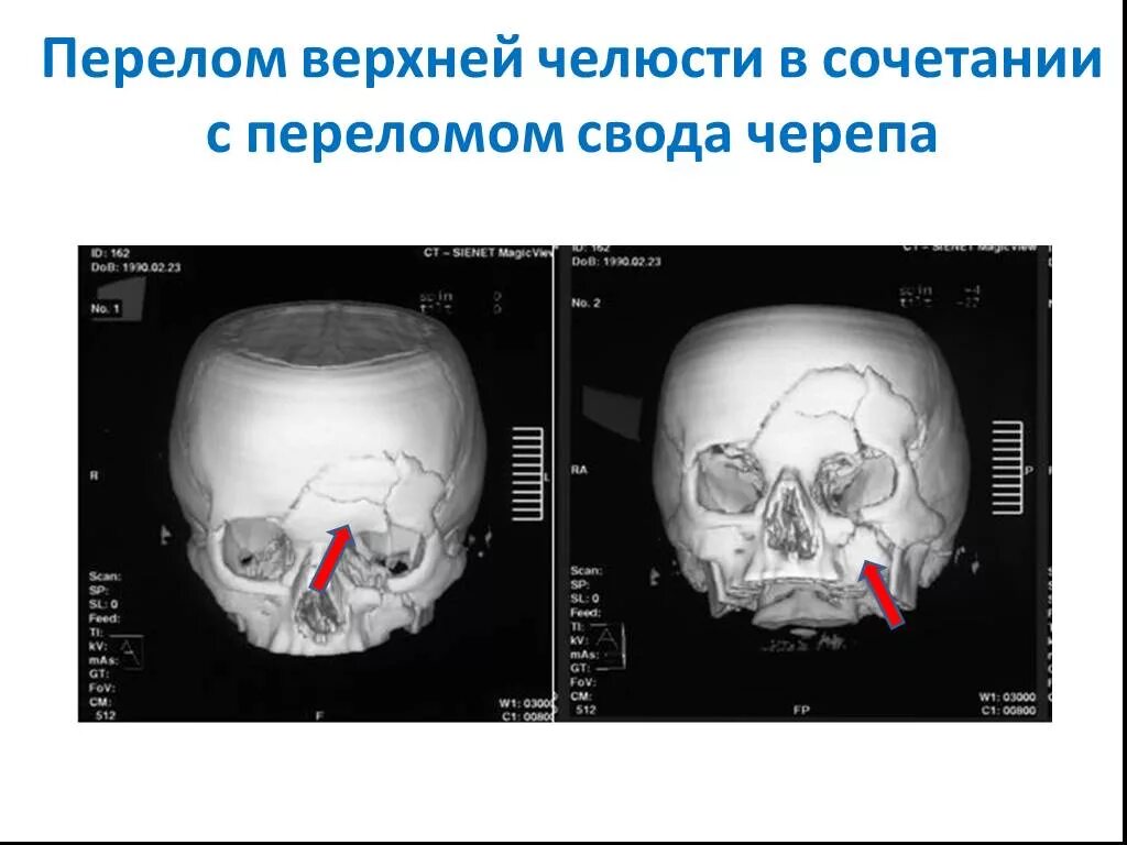 Перелом кости свода черепа. Оскольчатый перелом костей черепа. Переломы костей черепа на кт. Перелом костей свода черепа кт. Перелом лобной кости черепа.