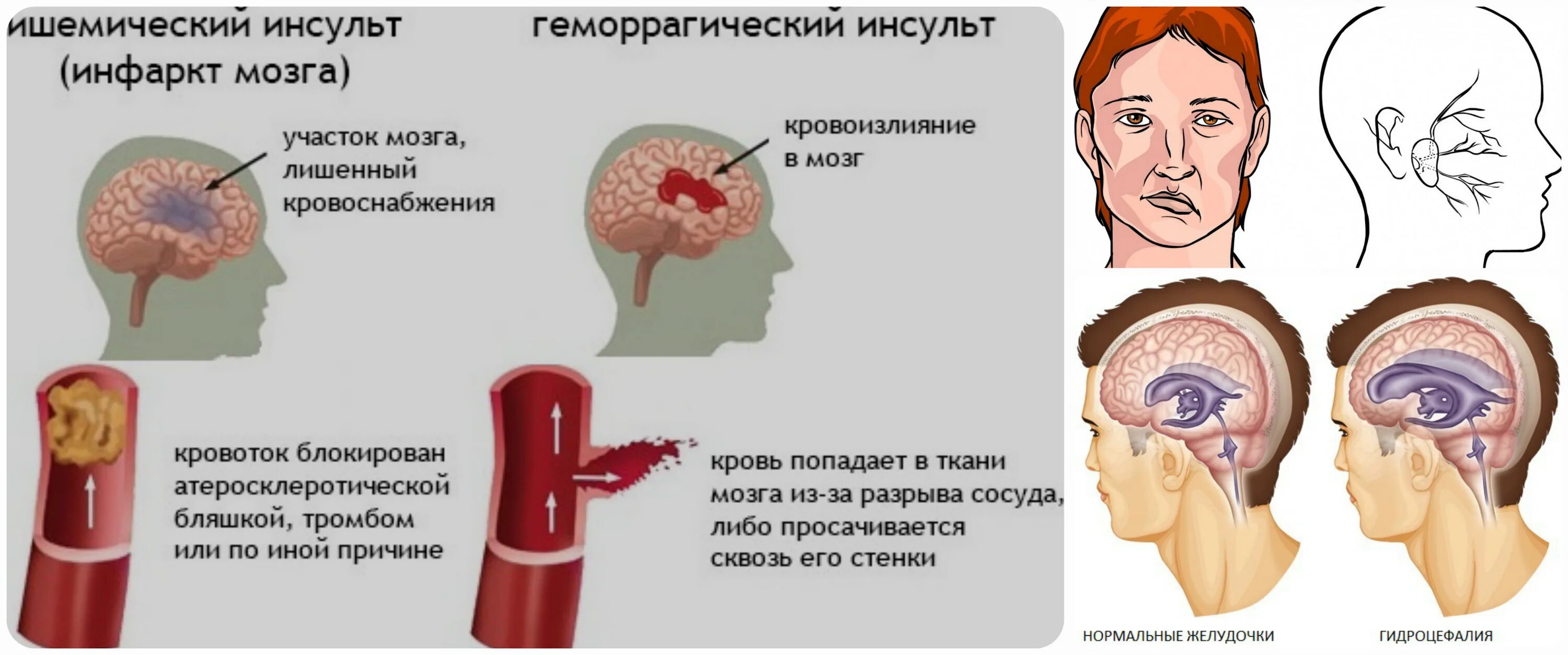 Признаки головного инсульта. Геморрагический инсульт. Геморрагический инсульт мозг. Геморрагический инсульт кровоизлияние в мозг. Мозг человека при инсульте.
