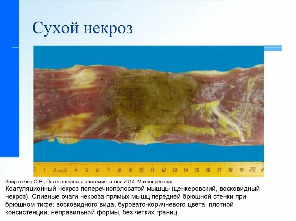Некроз тканей соприкасающихся с внешней средой называется. Коагуляционный (сухой) некроз.
