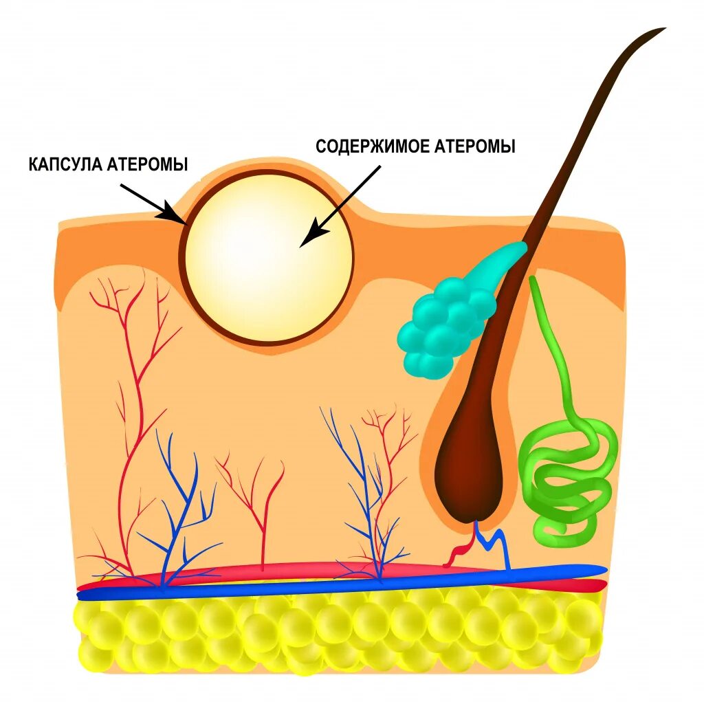 Атерома киста сальной железы. Капсула жировика